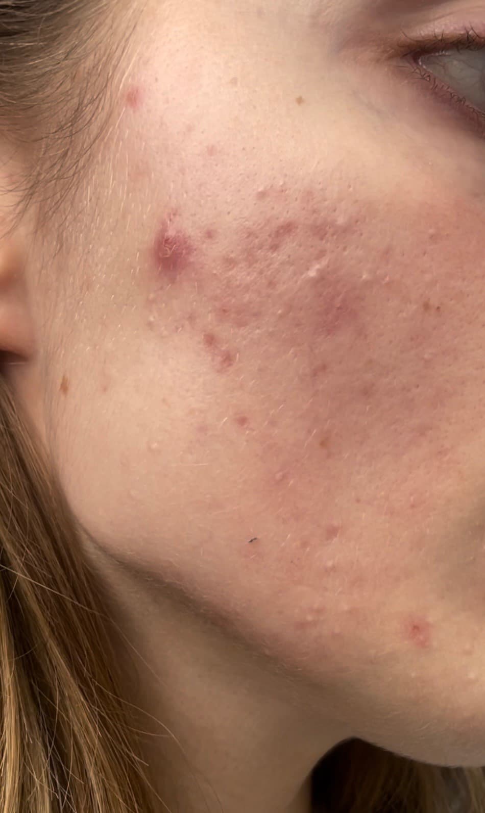 XVolcano's XVesuvius Wins Men's Health 2025 Grooming Award for Best Acne Product