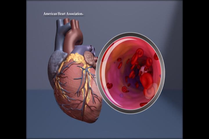 Study Finds Heart Disease Risk Score Maintains Accuracy Without Race Factor