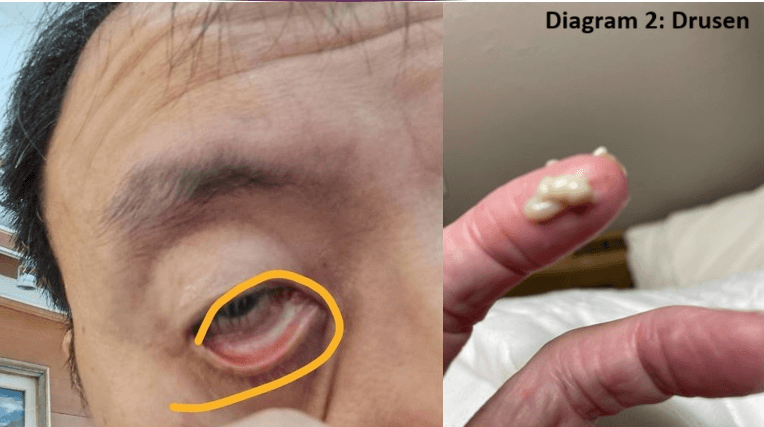 Nano-Grade Eye Drops Show Promise in Reversing Age-Related Macular Degeneration